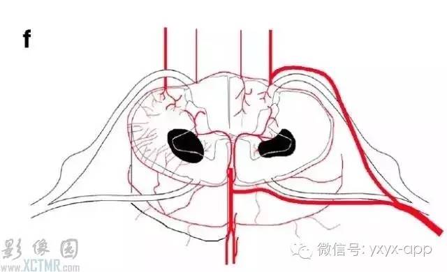 脊髓缺血综合征影像学评估 脊髓缺血综合征影像学评估