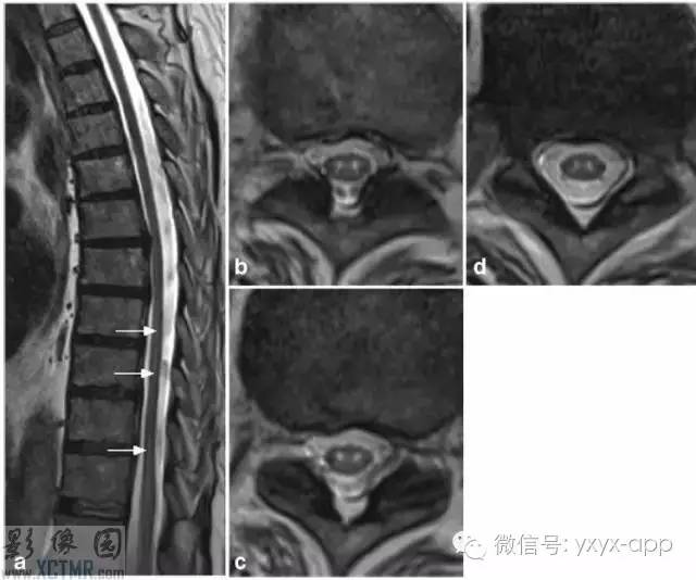 脊髓缺血综合征影像学评估 脊髓缺血综合征影像学评估