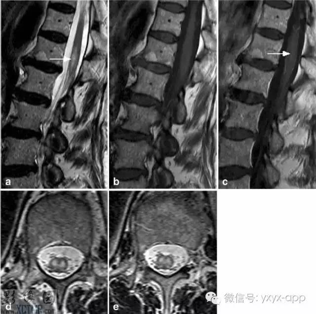 脊髓缺血综合征影像学评估 脊髓缺血综合征影像学评估