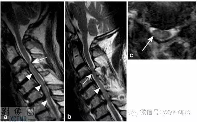 脊髓缺血综合征影像学评估 脊髓缺血综合征影像学评估