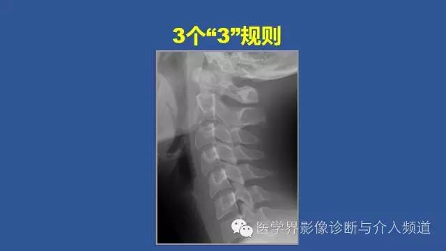 【PPT】颈椎骨折和脱位那些事