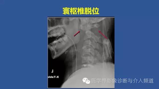 【PPT】颈椎骨折和脱位那些事