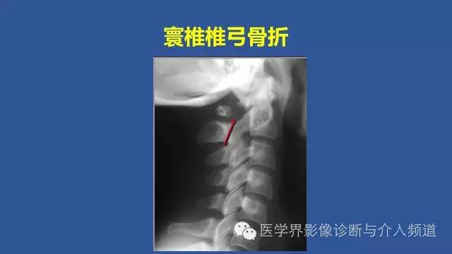 【PPT】颈椎骨折和脱位那些事