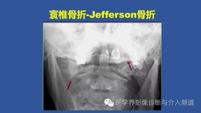 【PPT】颈椎骨折和脱位那些事