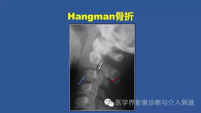 【PPT】颈椎骨折和脱位那些事