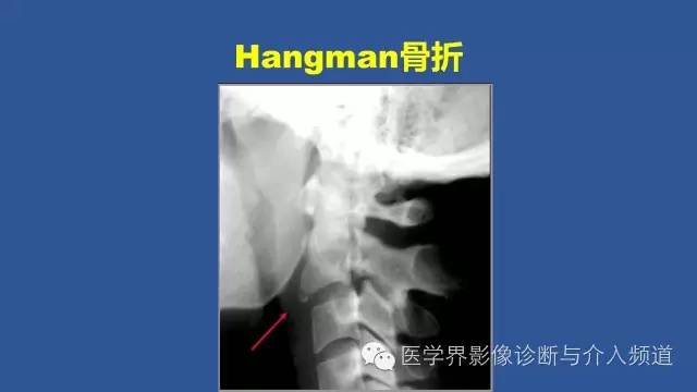 【PPT】颈椎骨折和脱位那些事