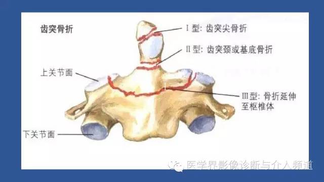 【PPT】颈椎骨折和脱位那些事