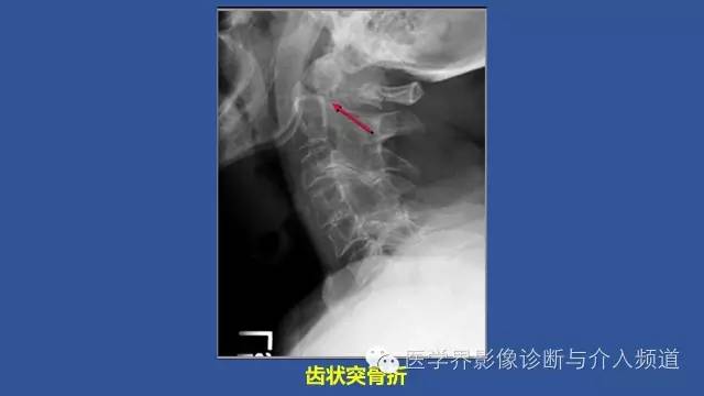 【PPT】颈椎骨折和脱位那些事