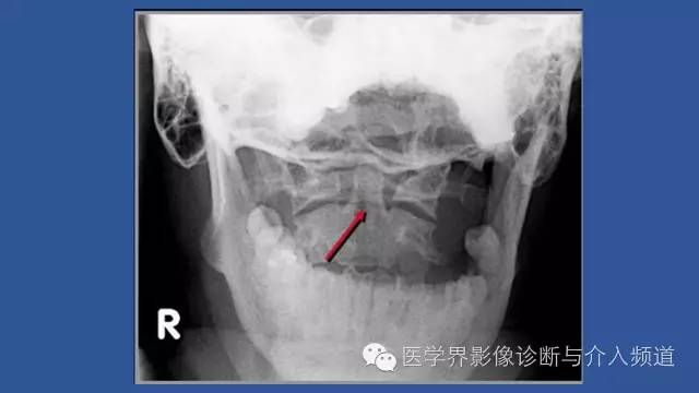 【PPT】颈椎骨折和脱位那些事
