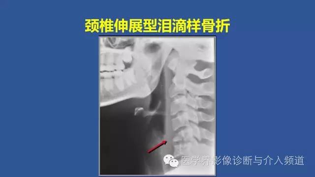 【PPT】颈椎骨折和脱位那些事