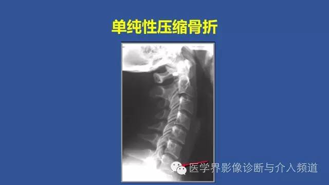 【PPT】颈椎骨折和脱位那些事
