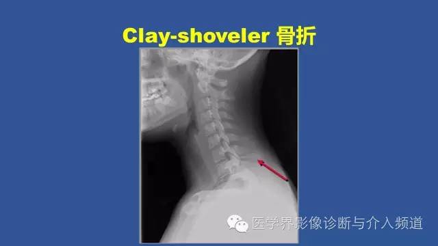 【PPT】颈椎骨折和脱位那些事