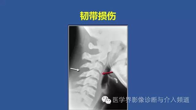【PPT】颈椎骨折和脱位那些事