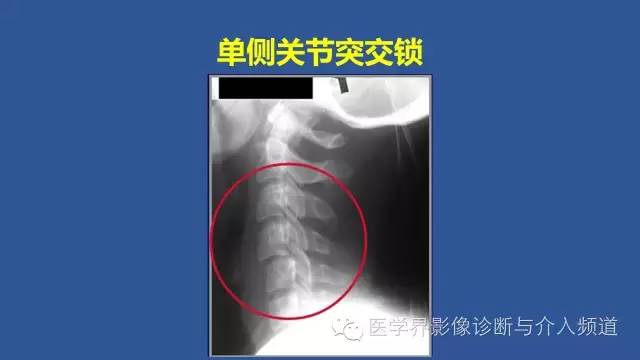 【PPT】颈椎骨折和脱位那些事