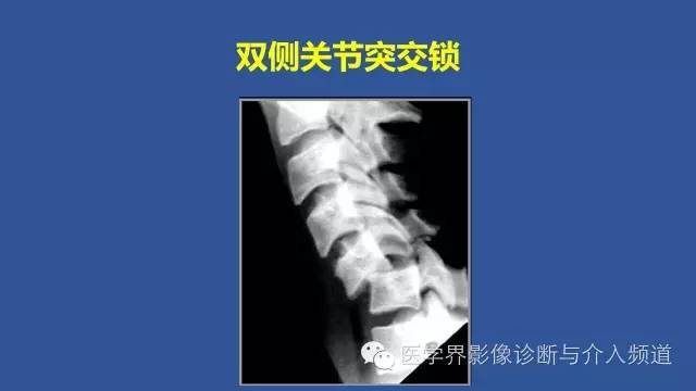 【PPT】颈椎骨折和脱位那些事