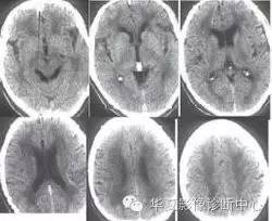 肾上腺脑白质营养不良