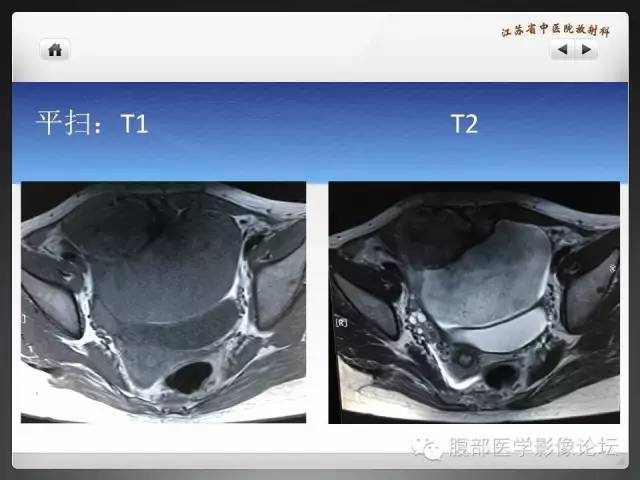 【病例】盆腔低度恶性纤维粘液样肉瘤1例MR影像表现 【病例】盆腔低度恶性纤维粘液样肉瘤1例MR影像表现