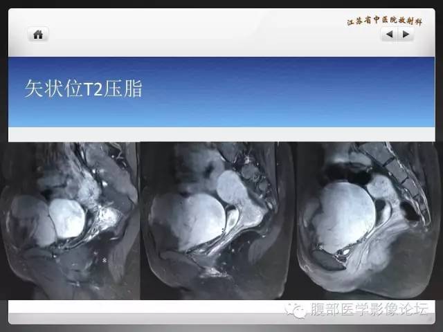 【病例】盆腔低度恶性纤维粘液样肉瘤1例MR影像表现 【病例】盆腔低度恶性纤维粘液样肉瘤1例MR影像表现