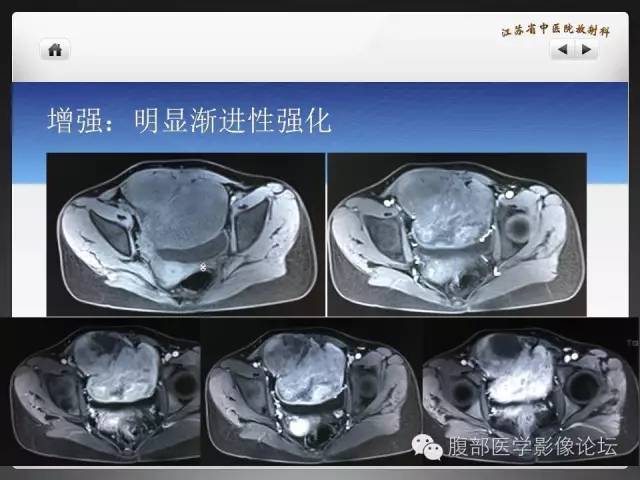 【病例】盆腔低度恶性纤维粘液样肉瘤1例MR影像表现 【病例】盆腔低度恶性纤维粘液样肉瘤1例MR影像表现