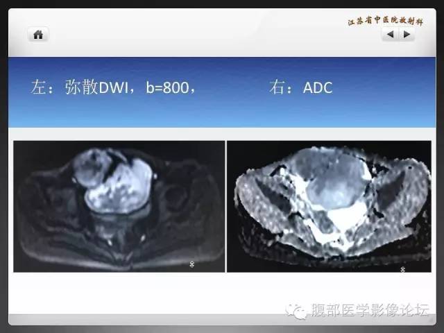 【病例】盆腔低度恶性纤维粘液样肉瘤1例MR影像表现 【病例】盆腔低度恶性纤维粘液样肉瘤1例MR影像表现