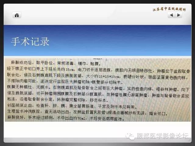 【病例】盆腔低度恶性纤维粘液样肉瘤1例MR影像表现 【病例】盆腔低度恶性纤维粘液样肉瘤1例MR影像表现