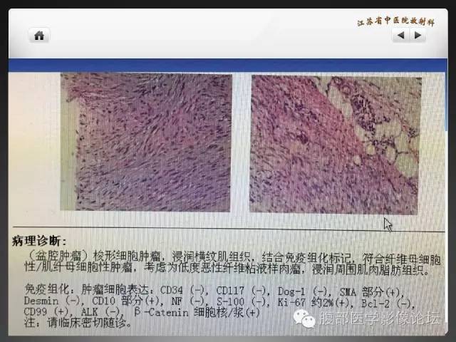 【病例】盆腔低度恶性纤维粘液样肉瘤1例MR影像表现 【病例】盆腔低度恶性纤维粘液样肉瘤1例MR影像表现