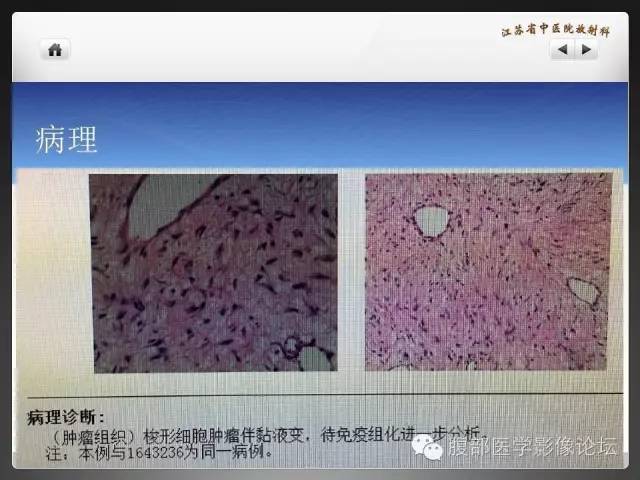 【病例】盆腔低度恶性纤维粘液样肉瘤1例MR影像表现 【病例】盆腔低度恶性纤维粘液样肉瘤1例MR影像表现