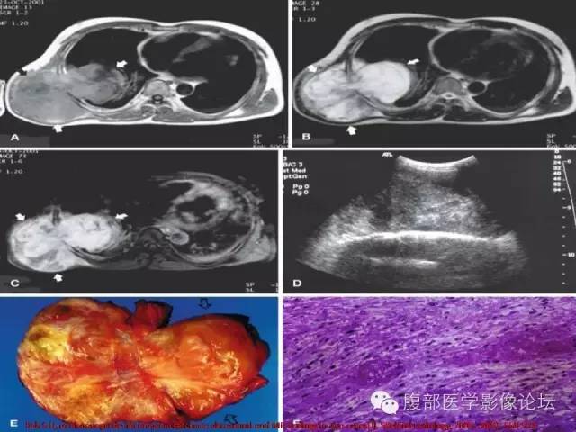 【病例】盆腔低度恶性纤维粘液样肉瘤1例MR影像表现 【病例】盆腔低度恶性纤维粘液样肉瘤1例MR影像表现