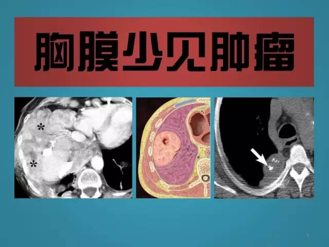 【PPT】胸膜少见肿瘤影像诊断