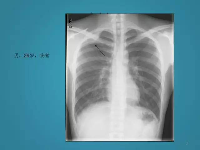 【PPT】胸膜少见肿瘤影像诊断