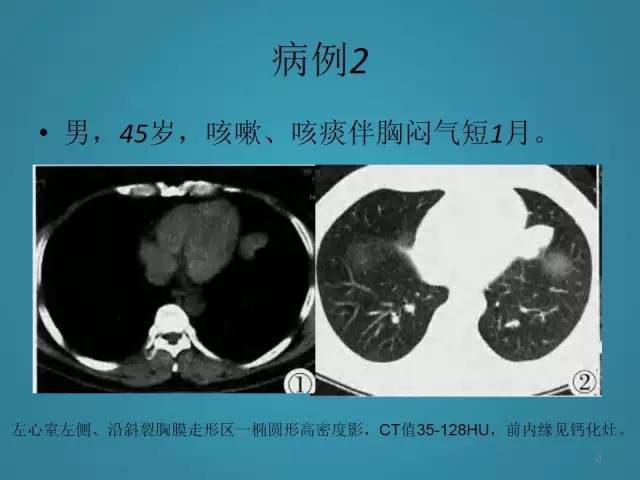 【PPT】胸膜少见肿瘤影像诊断