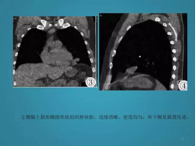 【PPT】胸膜少见肿瘤影像诊断