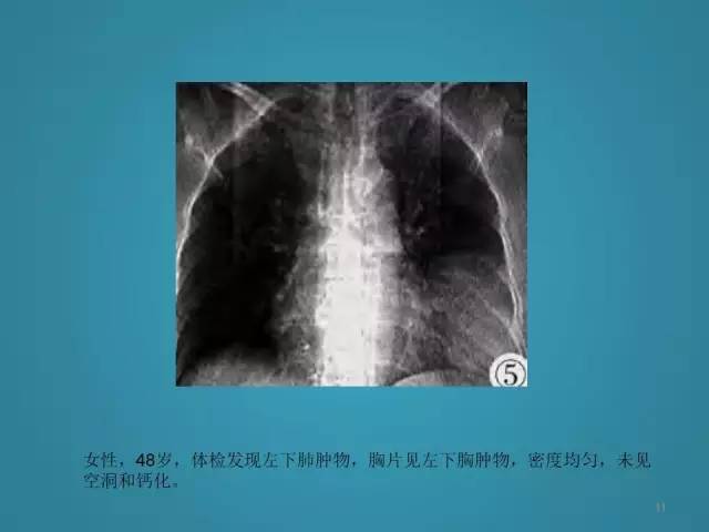 【PPT】胸膜少见肿瘤影像诊断