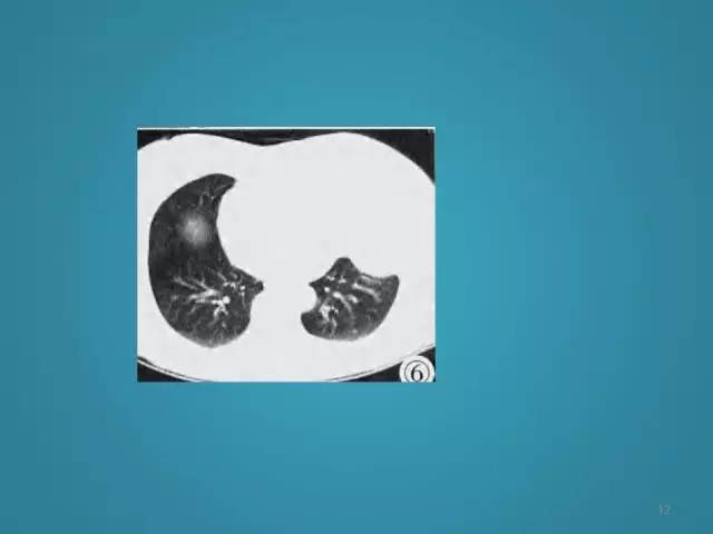 【PPT】胸膜少见肿瘤影像诊断