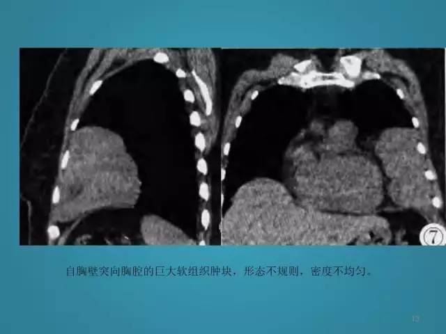 【PPT】胸膜少见肿瘤影像诊断