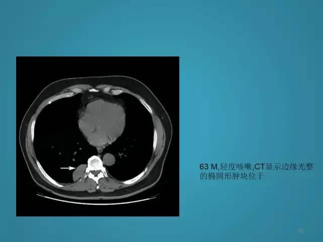 【PPT】胸膜少见肿瘤影像诊断