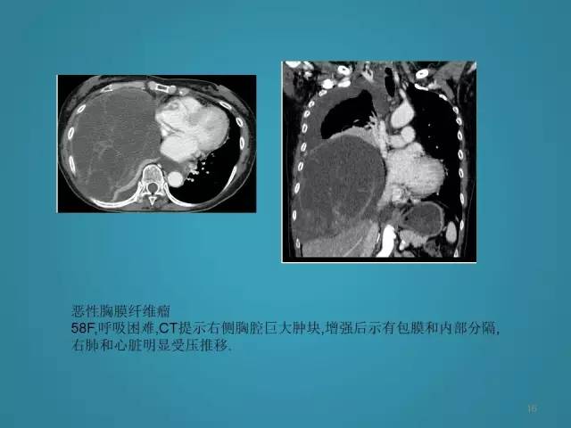 【PPT】胸膜少见肿瘤影像诊断