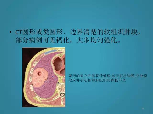 【PPT】胸膜少见肿瘤影像诊断