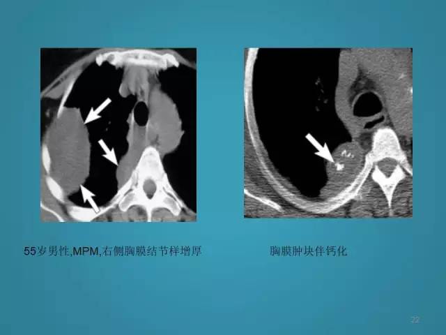 【PPT】胸膜少见肿瘤影像诊断