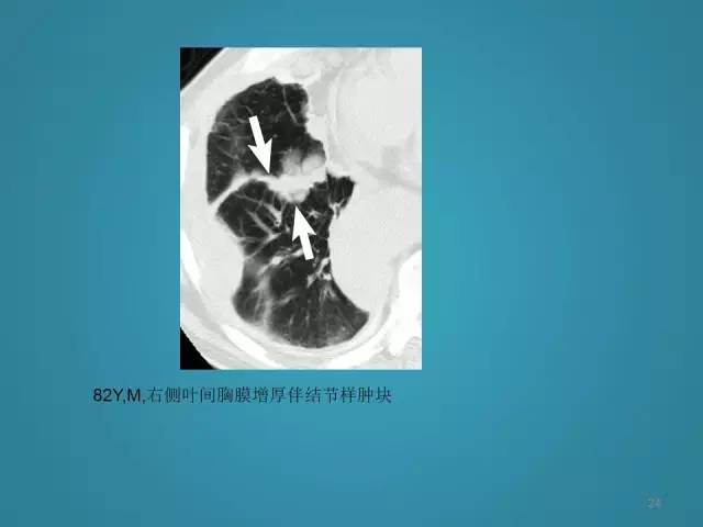 【PPT】胸膜少见肿瘤影像诊断