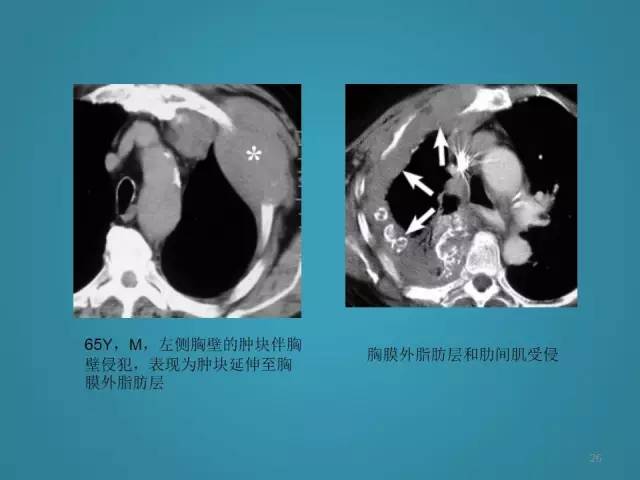 【PPT】胸膜少见肿瘤影像诊断