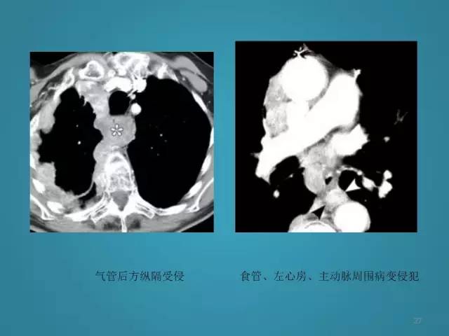 【PPT】胸膜少见肿瘤影像诊断