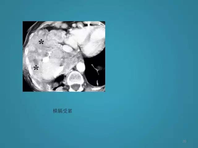【PPT】胸膜少见肿瘤影像诊断