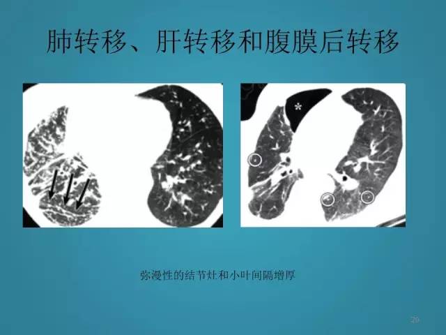 【PPT】胸膜少见肿瘤影像诊断