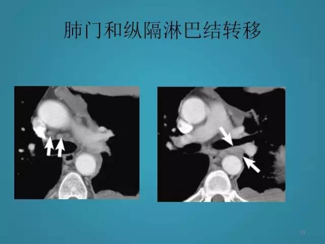 【PPT】胸膜少见肿瘤影像诊断