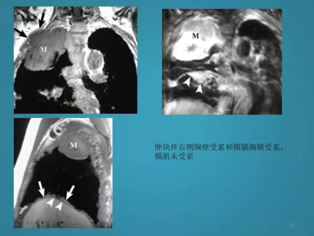 【PPT】胸膜少见肿瘤影像诊断