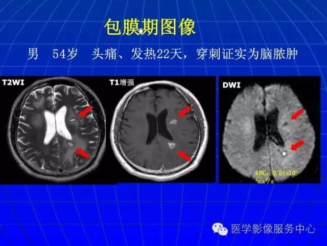 【PPT】脑脓肿磁共振加权成像动态变化