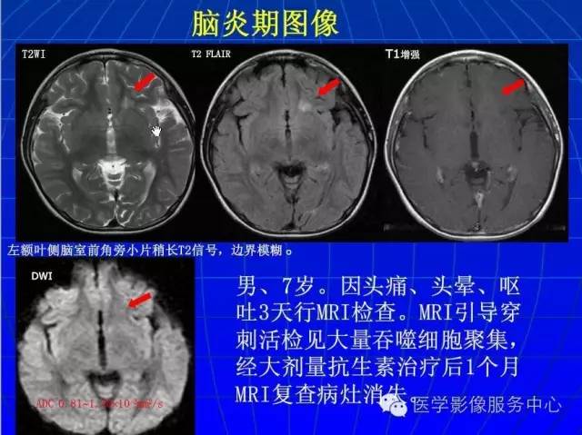 【PPT】脑脓肿磁共振加权成像动态变化