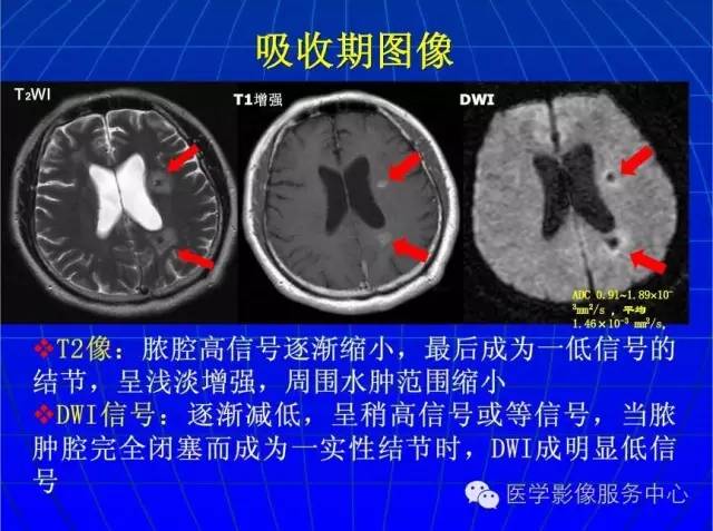 【PPT】脑脓肿磁共振加权成像动态变化