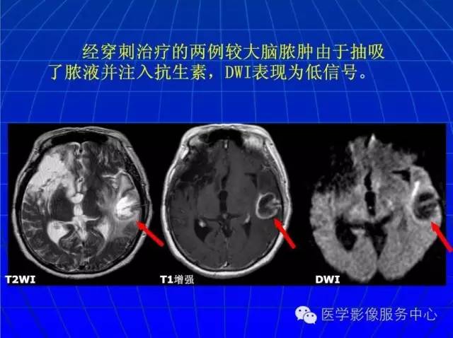 【PPT】脑脓肿磁共振加权成像动态变化